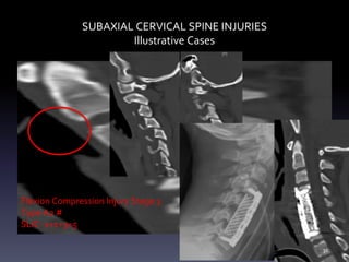 SUBAXIAL CERVICAL SPINE INJURIES
Illustrative Cases
Flexion Compression Injury Stage 3
Type A2 #
SLIC- 1+1+3=5
31
 