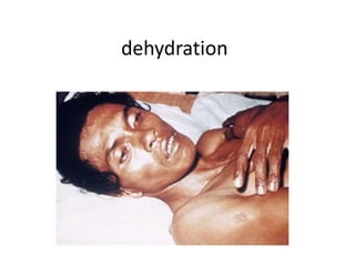 dehydration
 