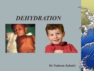 DEHYDRATION
Dr Nadeem Zubairi
 