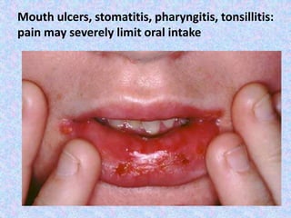 Mouth ulcers, stomatitis, pharyngitis, tonsillitis:
pain may severely limit oral intake
 
