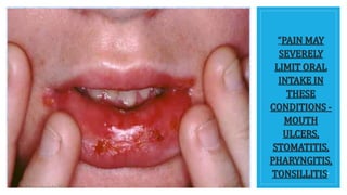 “PAIN MAY
SEVERELY
LIMIT ORAL
INTAKE IN
THESE
CONDITIONS -
MOUTH
ULCERS,
STOMATITIS,
PHARYNGITIS,
TONSILLITIS.”
 
