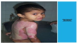 “BURNS”
 