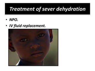 Treatment of sever dehydration
• NPO.
• IV fluid replacement.
 