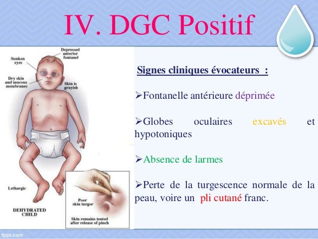 Deshydratation Aigue Du Nourrisson Deshydratation Aigue Du Nourrisson