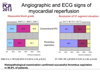 59.2
46.1
31.6
40.4
9.2
13.5
0% 20% 40% 60% 80% 100%
1
2
ST 70 ST 30-70 ST 30
21.1
30.8
36.8
42.3
42.1
26.9
0% 20% 40% 60% 80% 100%
1
2
MBG 0 or 1 MBG 2 MBG 3
.
. Conventional PCI
Thrombus
aspiration
Myocardial blush grade Resolution of ST-segment elevation
Percent of patients Percent of patients
MBG 0 or 1: RR 0,68 (95% CI 0,38 to 1,24; p=0,21) ST >70%: RR 1,28 (95% CI 0,91 to 1,82; p=0,16)
Angiographic and ECG signs of
myocardial reperfusion
Histopathological examination confirmed successful thrombus aspiration
in 90,8% of patients.
 