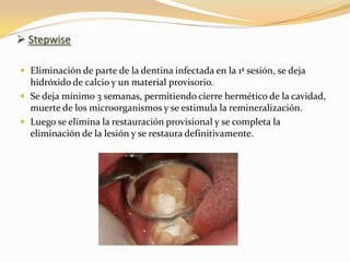  Stepwise

 Eliminación de parte de la dentina infectada en la 1ª sesión, se deja
  hidróxido de calcio y un material provisorio.
 Se deja mínimo 3 semanas, permitiendo cierre hermético de la cavidad,
  muerte de los microorganismos y se estimula la remineralización.
 Luego se elimina la restauración provisional y se completa la
  eliminación de la lesión y se restaura definitivamente.
 