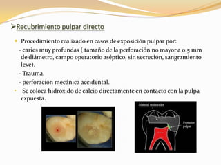 Recubrimiento pulpar directo
  Procedimiento realizado en casos de exposición pulpar por:
  - caries muy profundas ( tamaño de la perforación no mayor a 0.5 mm
   de diámetro, campo operatorio aséptico, sin secreción, sangramiento
   leve).
  - Trauma.
  - perforación mecánica accidental.
 • Se coloca hidróxido de calcio directamente en contacto con la pulpa
   expuesta.
 
