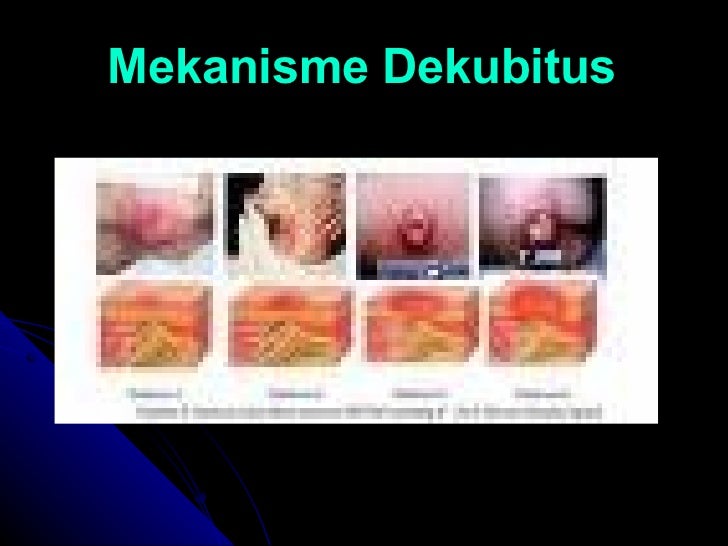 Perawatan Dekubitus