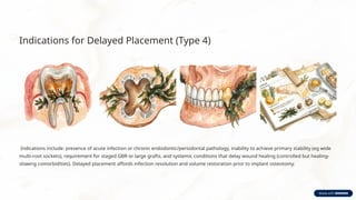 Delayed Implant Placement and Conventional Loading: Biological ...