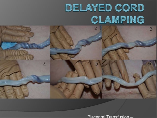 Delayed Cord Clamping delayed-cord-clamping