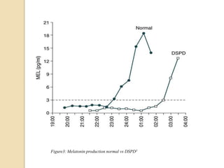 Delayed Sleep Phase Disorder(DSPD)[719].pptx