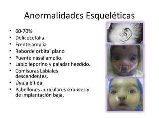 Anormalidades Esqueléticas
• 60-70%
• Dolicocefalia.
• Frente amplia.
• Reborde orbital plano
• Puente nasal amplio.
• Labio leporino y paladar hendido.
• Comisuras Labiales
  descendentes.
• Úvula bífida
• Pabellones auriculares Grandes y
  de implantación baja.
 