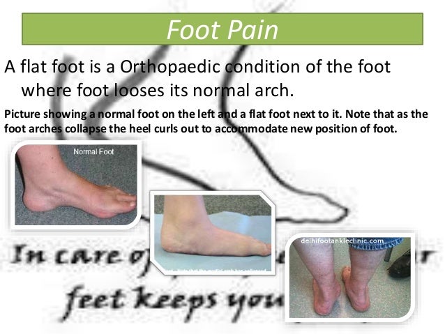 Diabetic Foot Treatment Flat Foot Diabetic Foot Treatment In India Fo 
