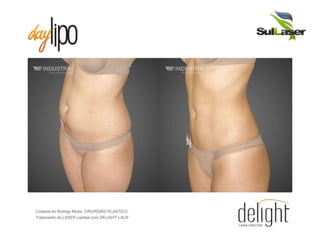 Cortesia de Rodrigo Motta, CIRURGIÃO PLASTICO.
Tratamento de LASER Lipólise com DELIGHT LAL®
 