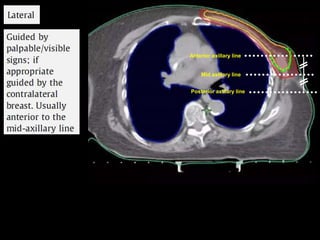 Delineation of breast cancer part iii | PPTX