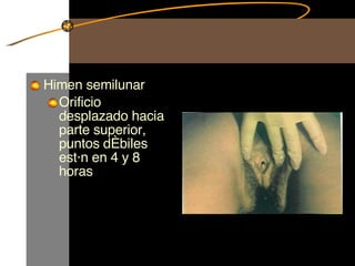 Himen semilunar Orificio desplazado hacia parte superior, puntos débiles están en 4 y 8 horas 