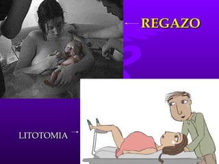 REGAZO LITOTOMIA 