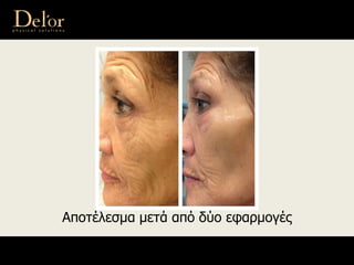 Αποτέλεσμα μετά από δύο εφαρμογές
 