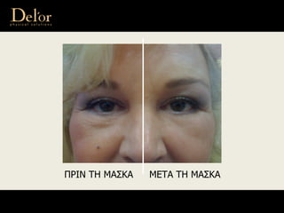 ΠΡΙΝ ΤΗ ΜΑΣΚΑ ΜΕΤΑ ΤΗ ΜΑΣΚΑ
 