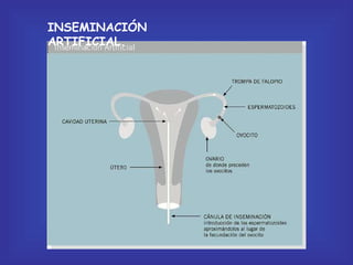 INSEMINACIÓN ARTIFICIAL. 