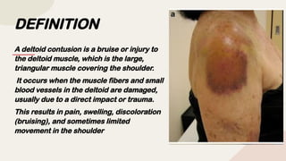 DEFINITION
A deltoid contusion is a bruise or injury to
the deltoid muscle, which is the large,
triangular muscle covering the shoulder.
It occurs when the muscle fibers and small
blood vessels in the deltoid are damaged,
usually due to a direct impact or trauma.
This results in pain, swelling, discoloration
(bruising), and sometimes limited
movement in the shoulder
 