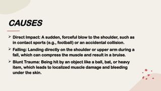 CAUSES
 Direct Impact: A sudden, forceful blow to the shoulder, such as
in contact sports (e.g., football) or an accidental collision.
 Falling: Landing directly on the shoulder or upper arm during a
fall, which can compress the muscle and result in a bruise.
 Blunt Trauma: Being hit by an object like a ball, bat, or heavy
item, which leads to localized muscle damage and bleeding
under the skin.
 