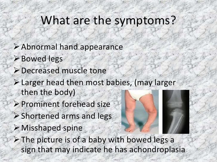 achondroplasia 4 achondroplasia 4