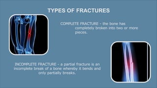 Fractures all there is about fractures yay | PPTX