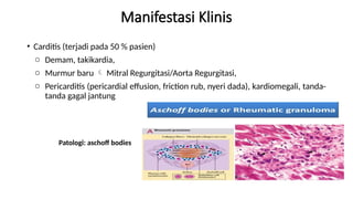 Manifestasi Klinis
• Carditis (terjadi pada 50 % pasien)
o Demam, takikardia,
o Murmur baru  Mitral Regurgitasi/Aorta Regurgitasi,
o Pericarditis (pericardial effusion, friction rub, nyeri dada), kardiomegali, tanda-
tanda gagal jantung
Patologi: aschoff bodies
 