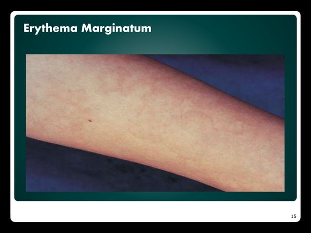 Demam reumatik | PPTX