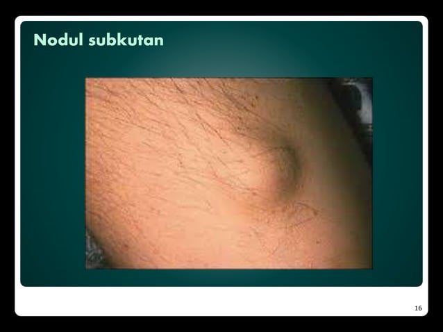 Demam reumatik | PPTX