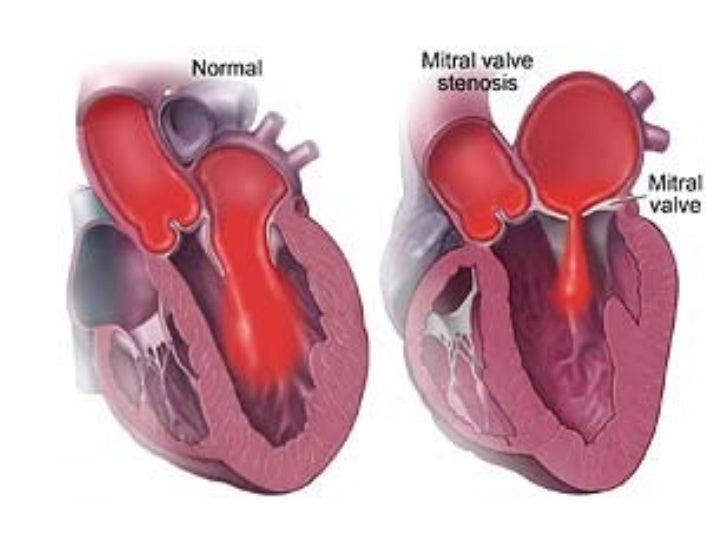 Сердечный стеноз. Стеноз митрального клапана сердца. Стеноз предсердно желудочкового отверстия. Приобретенные пороки митрального клапана. Приобретенные пороки сердца митральный стеноз.