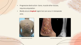 • Progressive destruction- bone, muscle other tissues,
requires amputation.
• Mostly occurs tropical region but can occur in temperate
zone.
Multiple draining sinuses Lytic bone lesions on X-ray
 