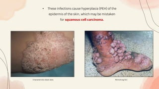 • These infections cause hyperplasia (PEH) of the
epidermis of the skin, which may be mistaken
for squamous cell carcinoma.
Characteristic black dots Mimicking SCC
 