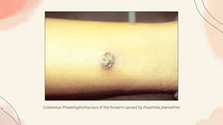 Cutaneous Phaeohyphomycosis of the forearm caused by Exophiala jeanselmei
 
