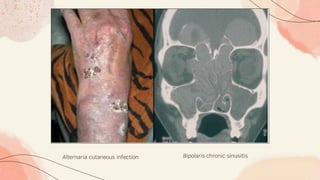 Alternaria cutaneous infection Bipolaris chronic sinusitis
 