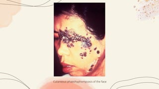 Cutaneous phaeohyphomycosis of the face
 
