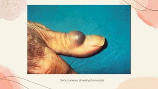 Subcutaneous phaeohyphomycosis
 
