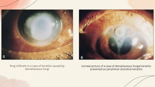 Ring infiltrate in a case of keratitis caused by
dematiaceous fungi
Corneal picture of a case of dematiaceous fungal keratitis
presented as peripheral ulcerative keratitis
 