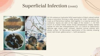 Superficial Infection (cont)
(a) 10% potassium hydroxide (KOH) examination of black colored nodule
shows a concretion forming a collar around hair shaft. Concretions are
made up of filamentous hyphae, held together in a mass by cement like
substance. Spores are seen at the edges of the nodule (←), (b) KOH
mount of crushed nodule shows brown dematiaceous closely septate
hyphae (H) with few chlamydospores (Ch). (c) Culture on Sabouraud's
dextrose agar shows small, compact, blackish conical colonies with
velvety surface. (d) Microscopic examination of the colonies showing
round, dark brown, globus ascus (→) with ascospores.
 