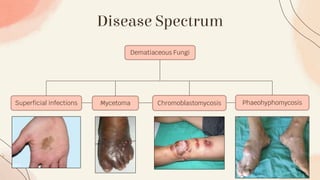 Disease Spectrum
Dematiaceous Fungi
Superficial infections Mycetoma Chromoblastomycosis Phaeohyphomycosis
 