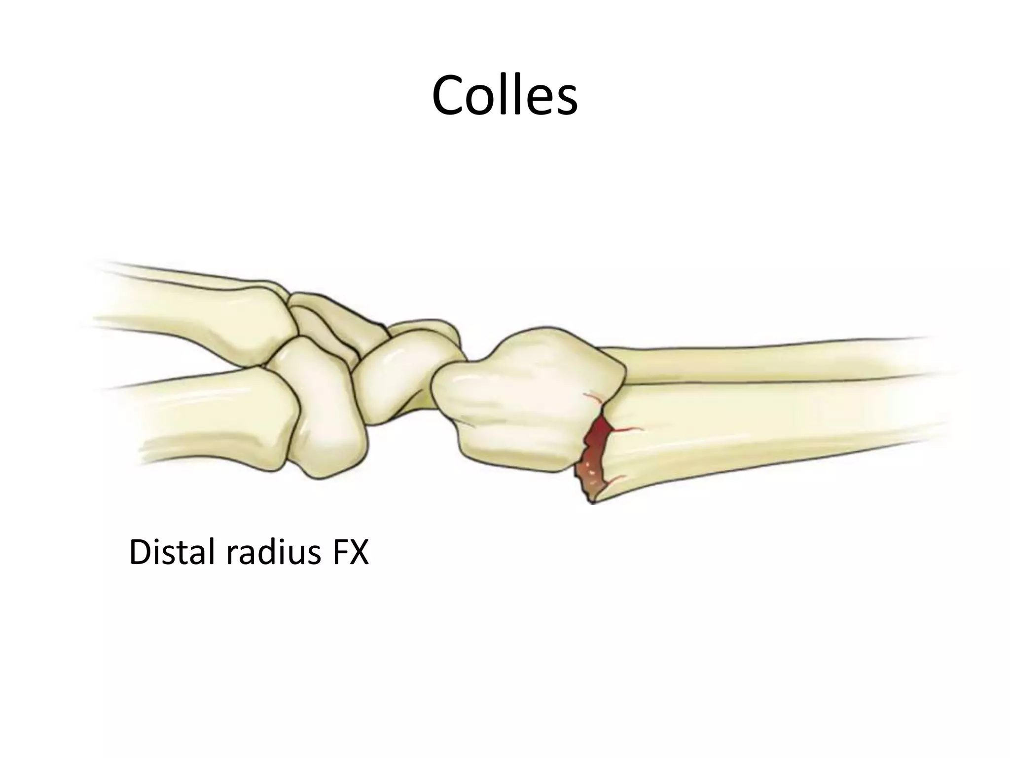 Colles




Distal radius FX
 