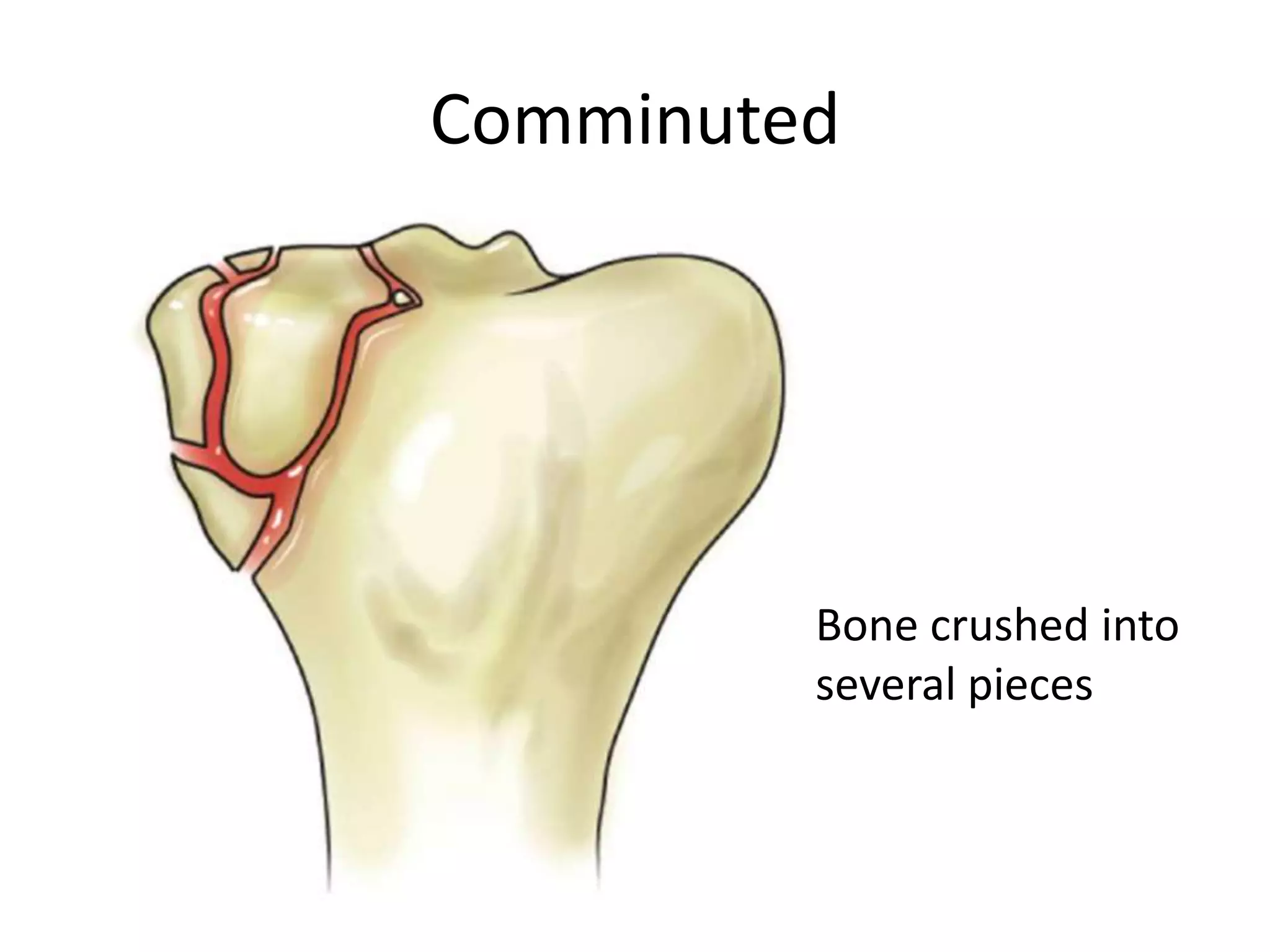 Comminuted




         Bone crushed into
         several pieces
 