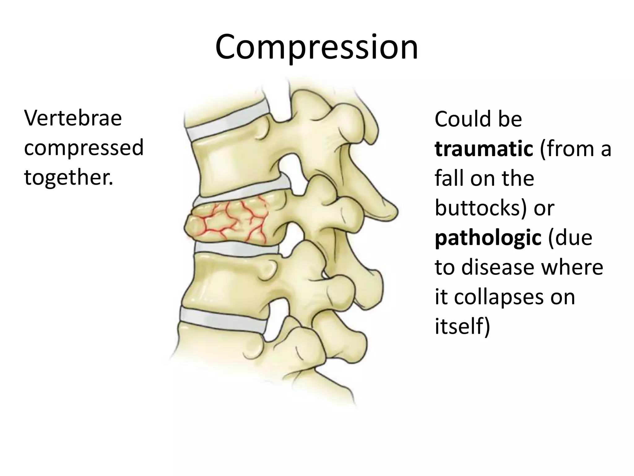 Compression
Vertebrae                  Could be
compressed                 traumatic (from a
together.                  fall on the
                           buttocks) or
                           pathologic (due
                           to disease where
                           it collapses on
                           itself)
 