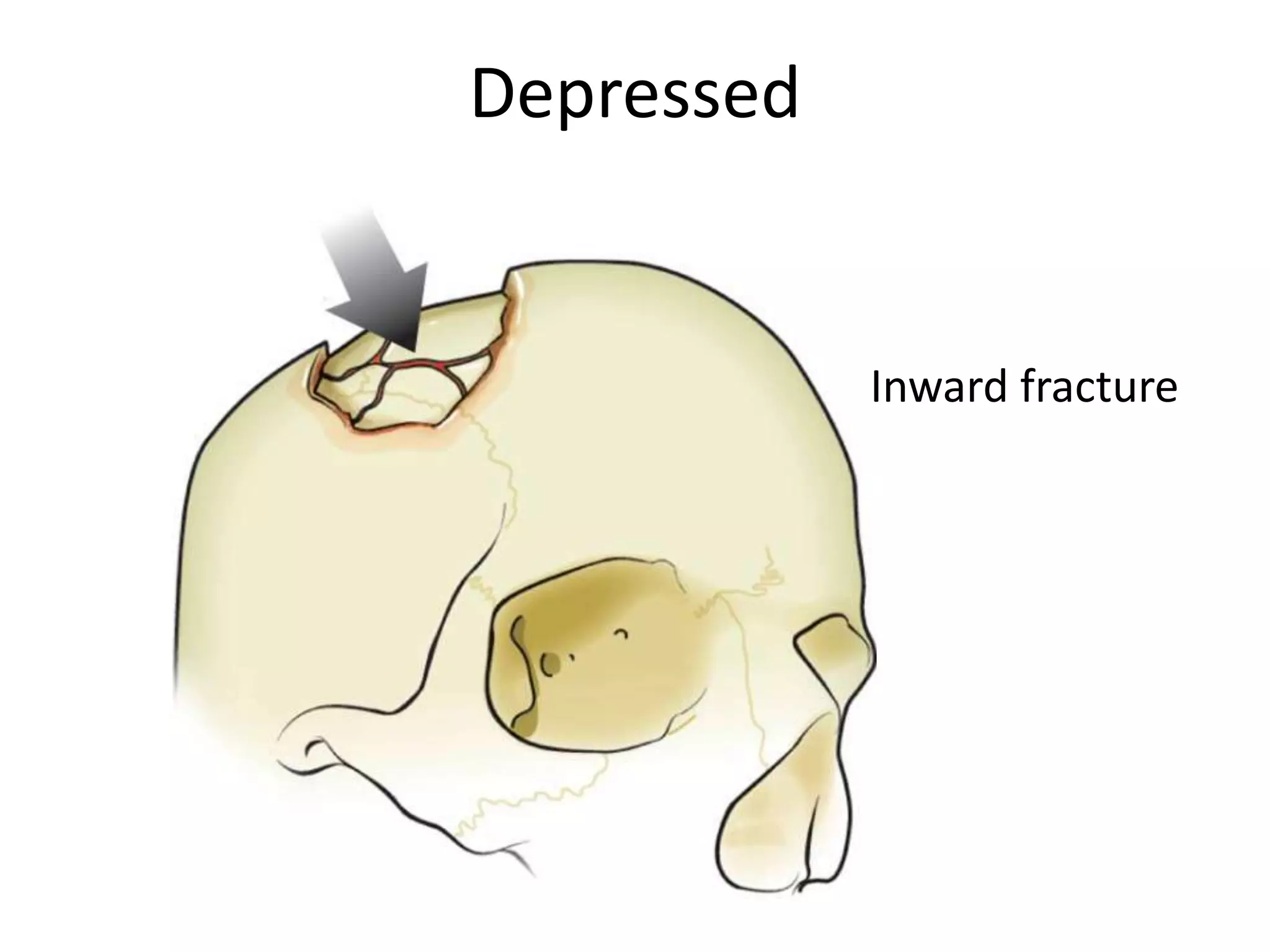 Depressed


            Inward fracture
 
