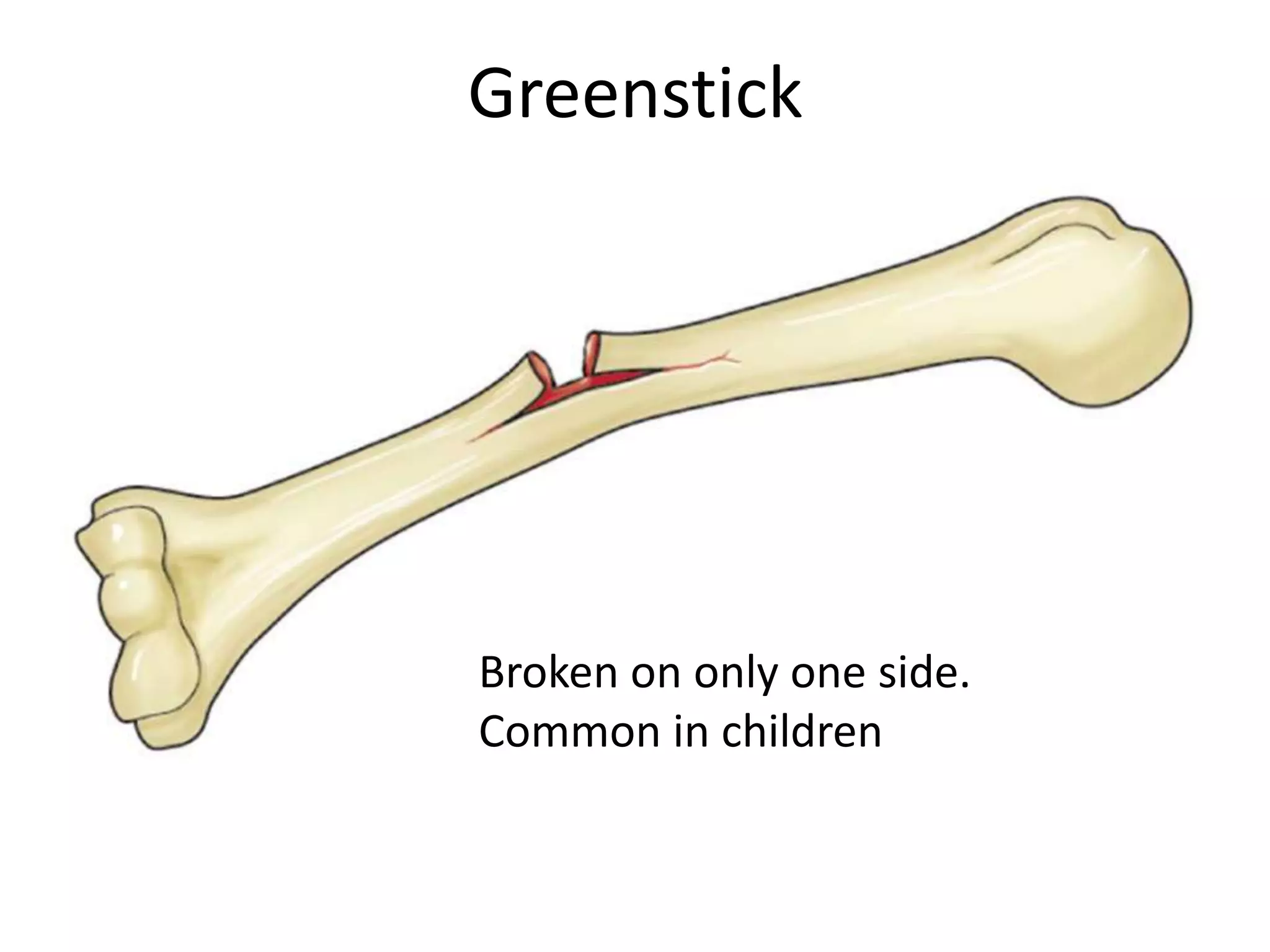 Greenstick




Broken on only one side.
Common in children
 