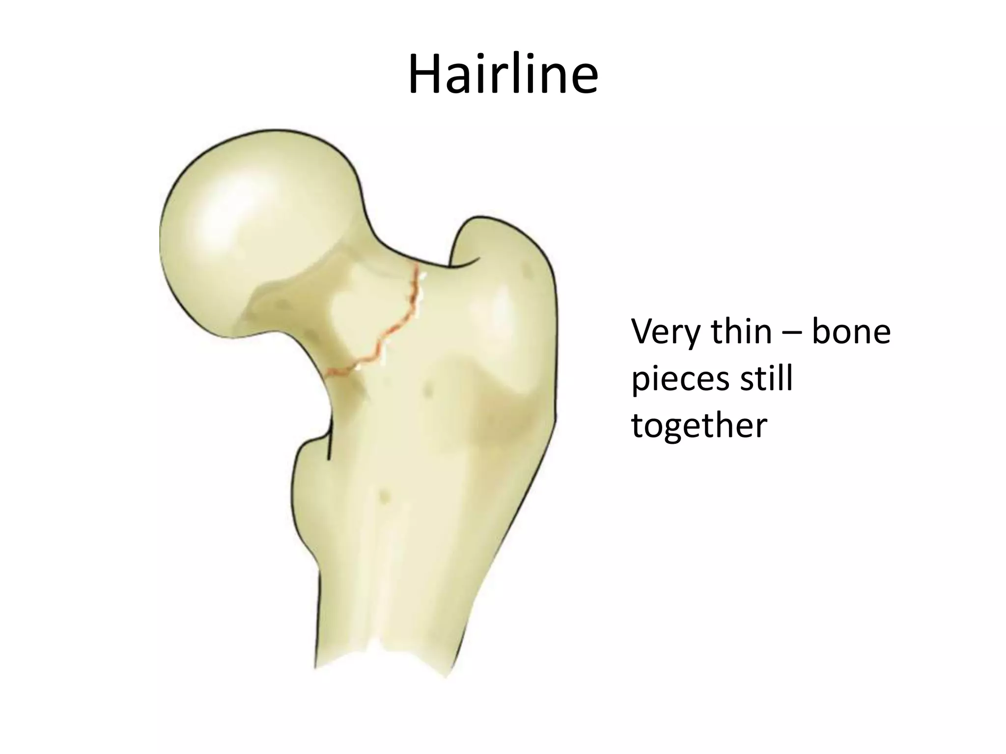 Hairline



           Very thin – bone
           pieces still
           together
 