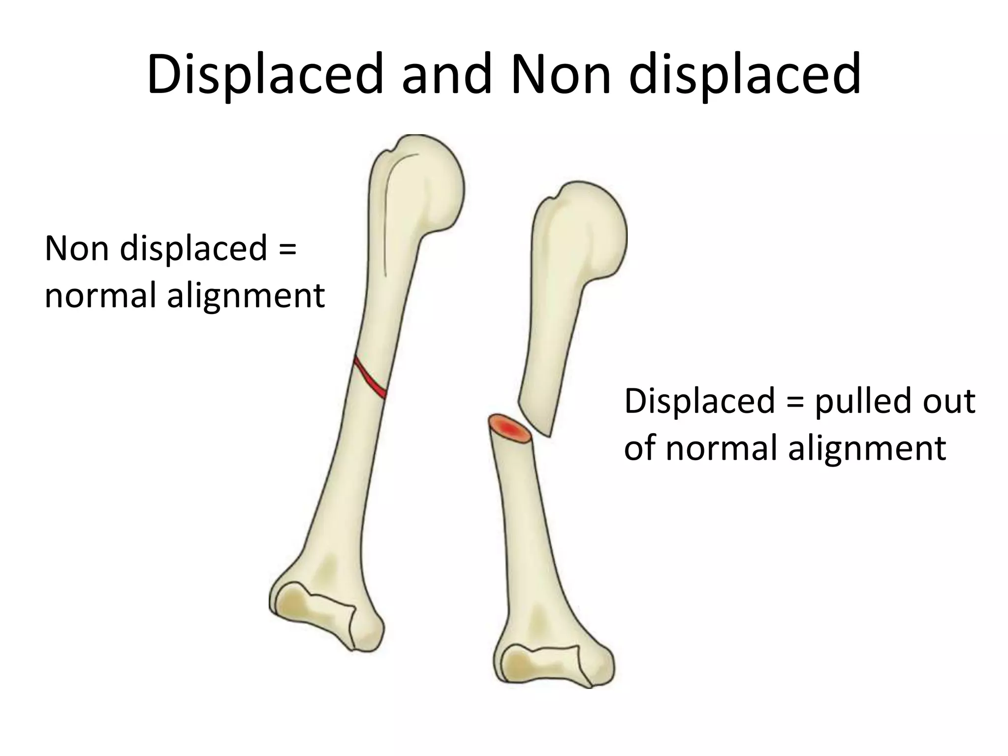 Displaced and Non displaced

Non displaced =
normal alignment

                      Displaced = pulled out
                      of normal alignment
 