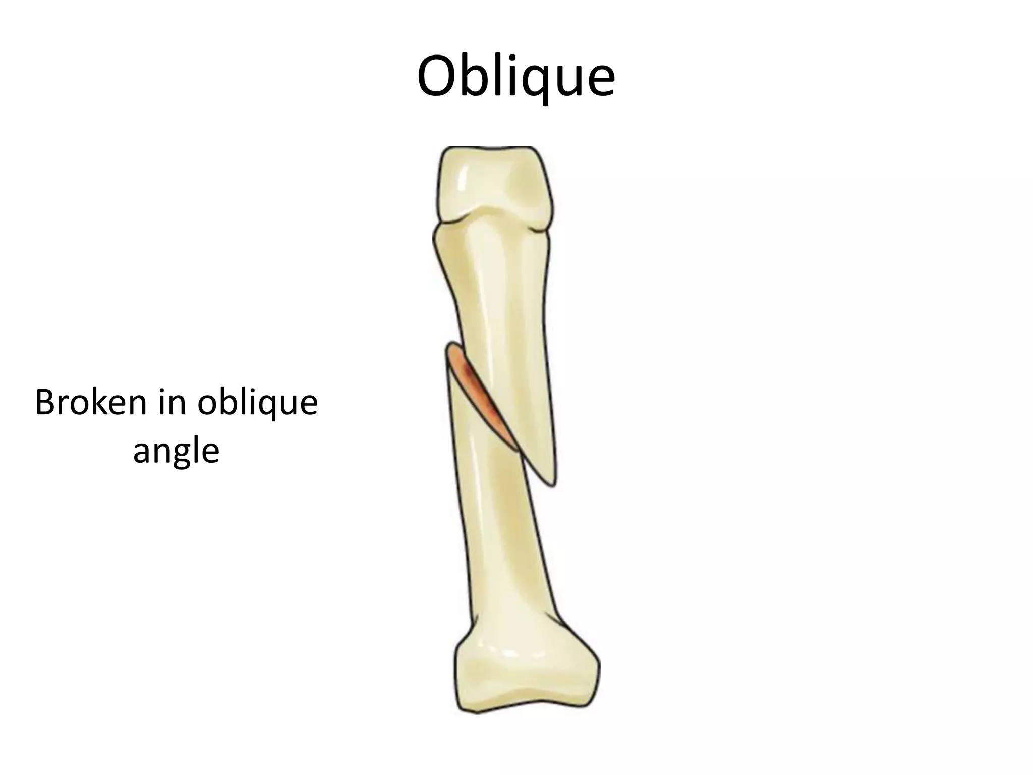 Oblique




Broken in oblique
     angle
 