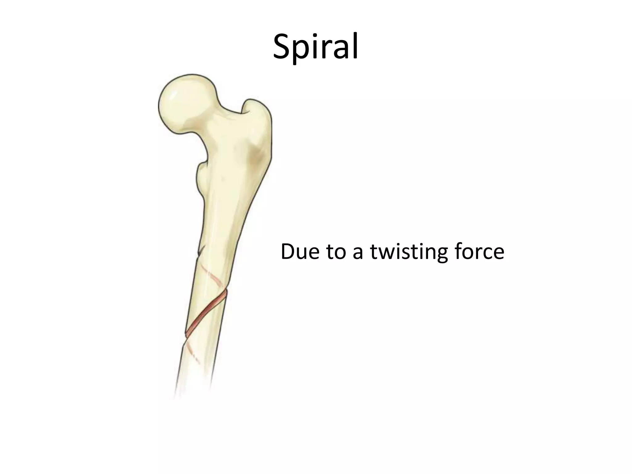 Spiral




Due to a twisting force
 